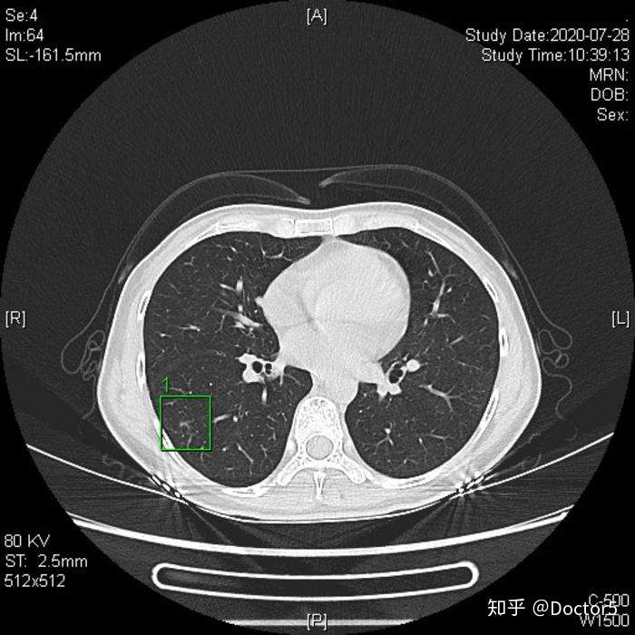 肺磨玻璃结节 小结节进展形成的微浸润腺癌 肺癌可以完全治愈的最后一道防线 千万不能耽误 知乎