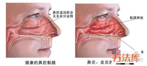 鼻炎怎么用药都没效果 药用对方法了吗 知乎 鼻炎怎么用药都没效果 药用对方法了吗 知乎
