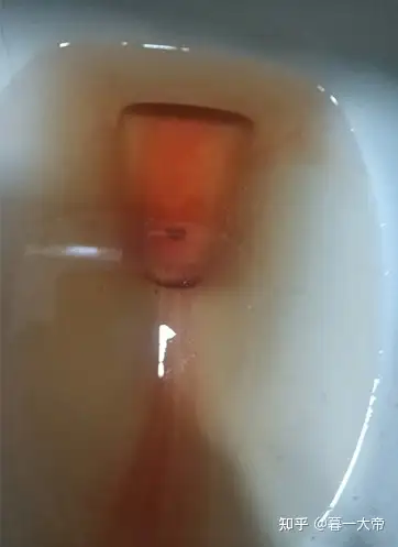 多年肾结石的战斗经验 - 知乎