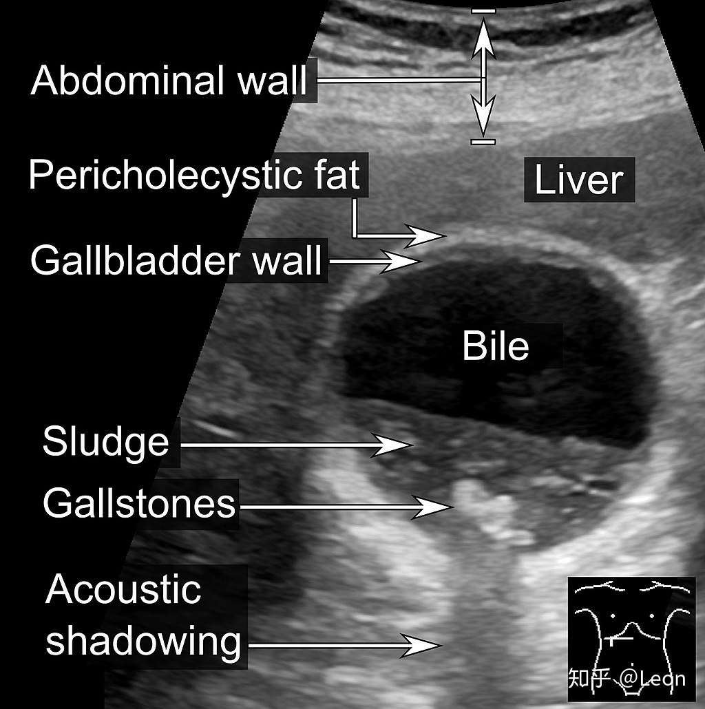 胆囊炎cholecystitis 知乎