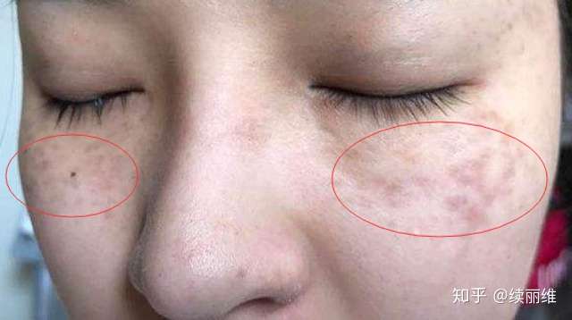色斑怎么祛 先得了解你长的是什么斑 知乎