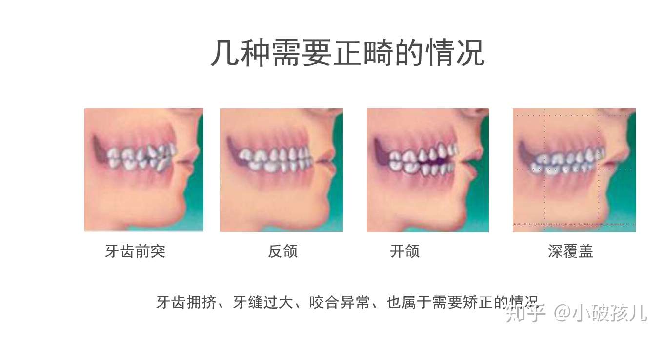 牙齿矫正的详细流程以及矫正器种类的介绍 知乎