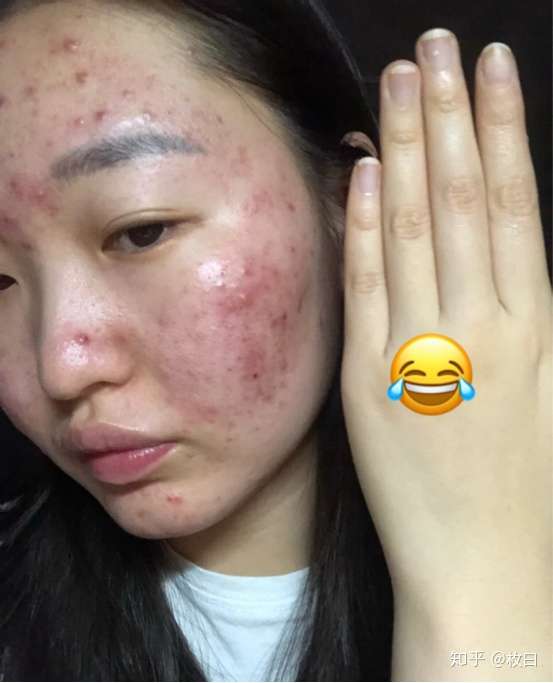 如何去除脸上的痘痘,痘印和痘坑呢?请帮忙!