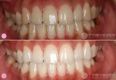 怎么让牙齿变白