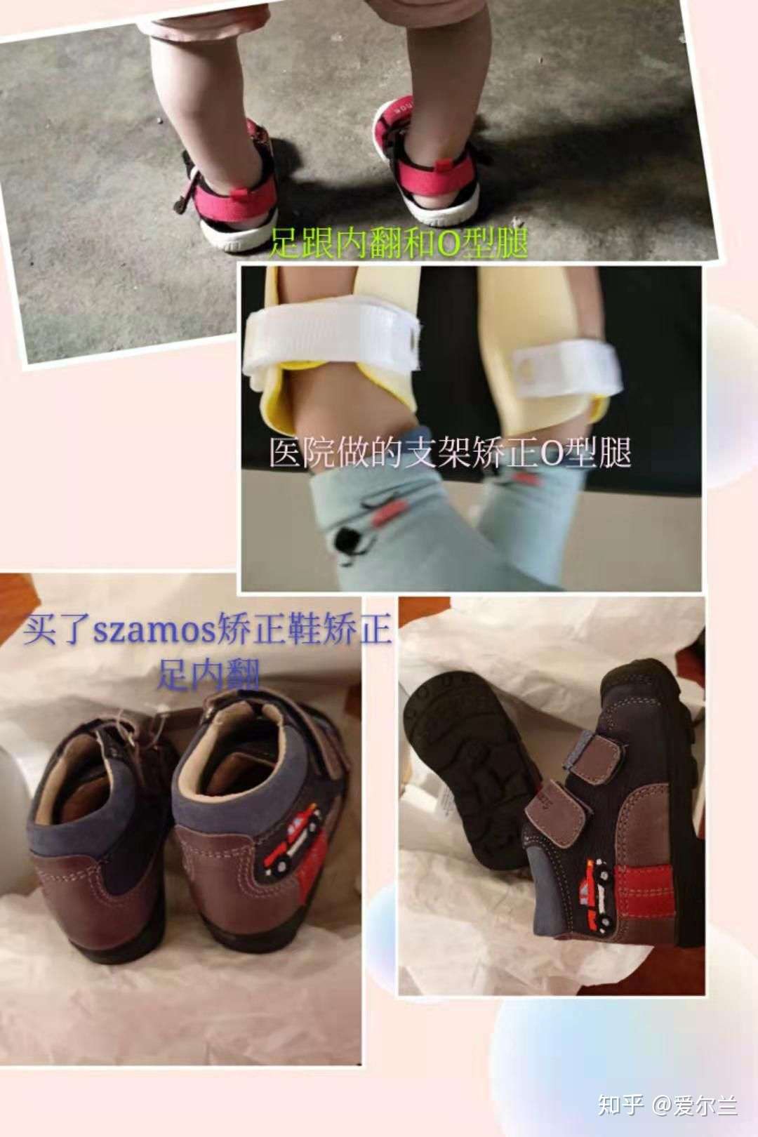 穿矫正鞋一段时间后宝宝偏平足逆袭漂亮足弓 知乎 穿矫正鞋一段时间后宝宝偏平足逆袭漂亮足弓 知乎