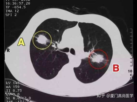 petct是怎樣辨別良惡性疾病的