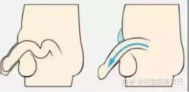 俗称:拔苗助长先来说一下丁丁延长术:那些变大手术和药物真的有用吗?