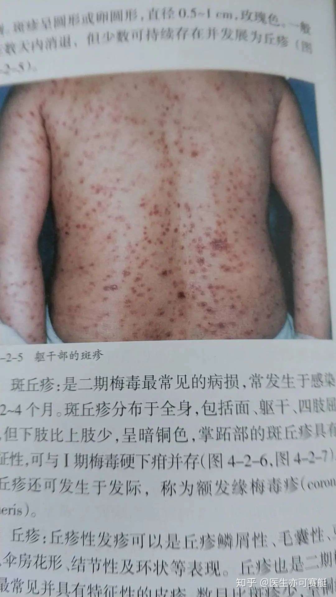 梅毒并不可怕 带你揭开梅毒的面纱 知乎