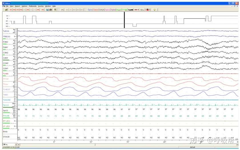 带您解读字psg 睡眠多项生理检查 报告 建议收藏 知乎