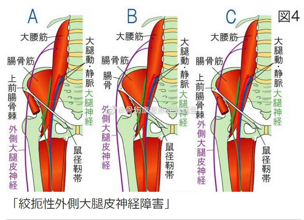 股外侧皮神经阻滞定位图片