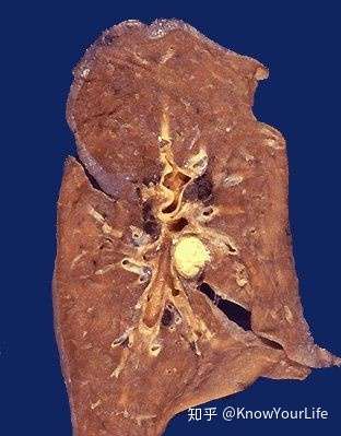 肺中间的黄色部分就是干酪样坏死