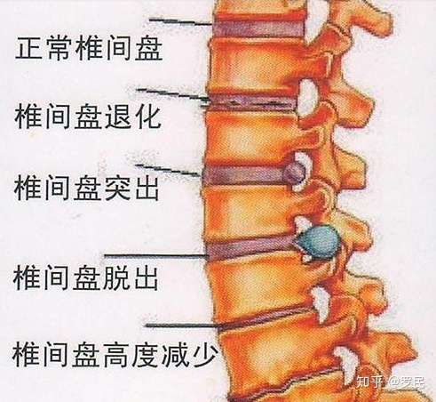 年纪轻轻得了颈椎病 颈椎间盘突出怎么办 以后几十年怎么过 知乎