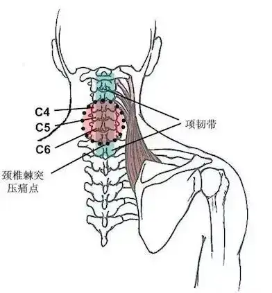 肩颈突然痛到不能动,年轻人肩颈疼怎么调理插图4 肩颈突然痛到不能动,年轻人肩颈疼怎么调理插图4