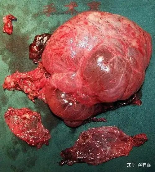 肺气肿肺大泡是如何形成的 如何预防破裂和加重 知乎