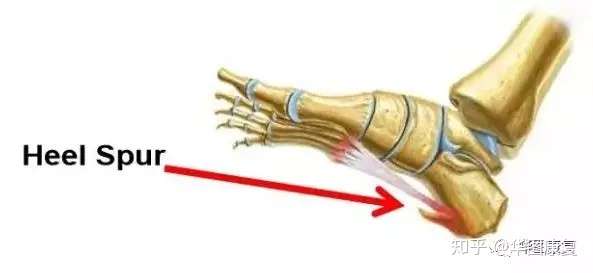 五招远离足跟痛 知乎