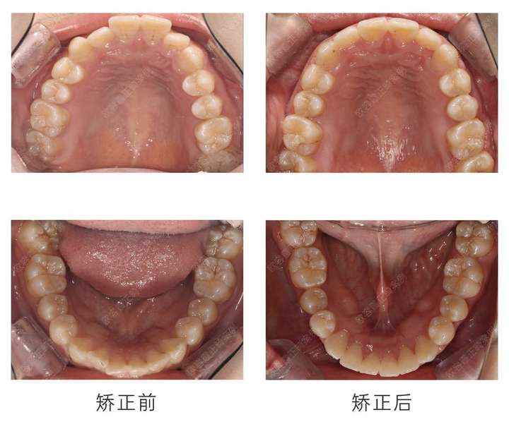 深圳牙齿矫正案例之欧容霞篇