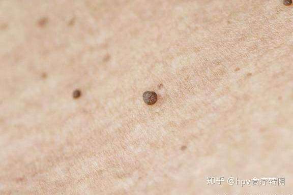 重置] 2人 赞同了该文章 24岁的小芳最近发现脸上突然冒出一些小疣子