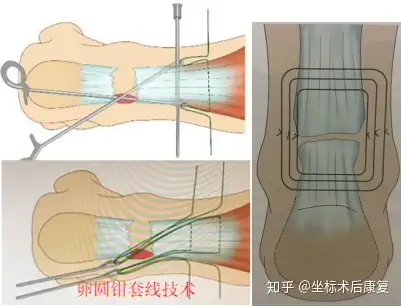 跟腱斷裂的治療方式微創篇