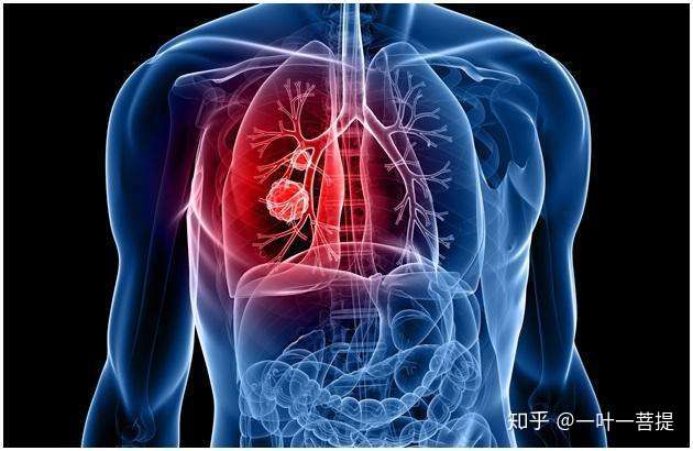 肺癌四种类型 肺腺癌 肺鳞癌 小细胞肺癌 有什么特点 怎么治疗 知乎