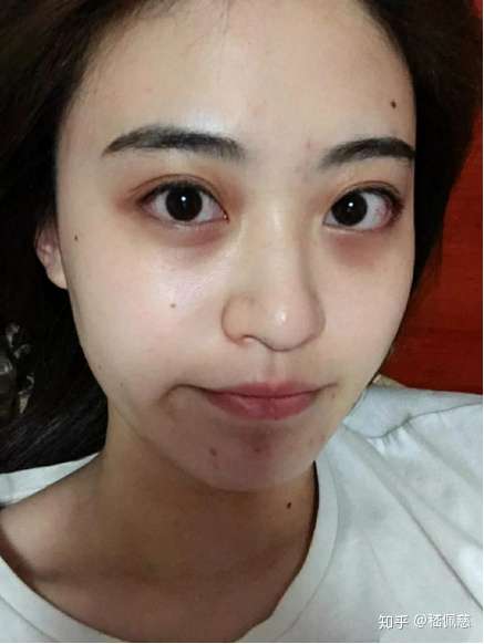有没有可以去黑眼圈的好办法?