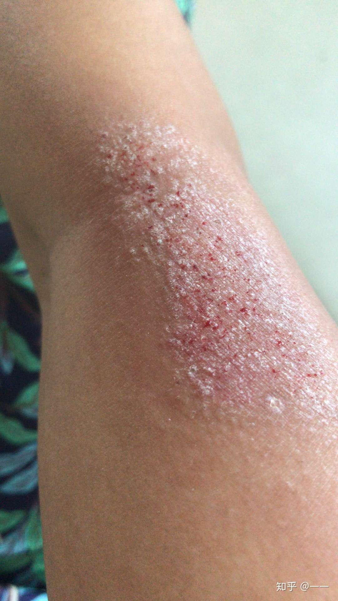 今天我想写一下我的神经性皮炎怎么弄好的