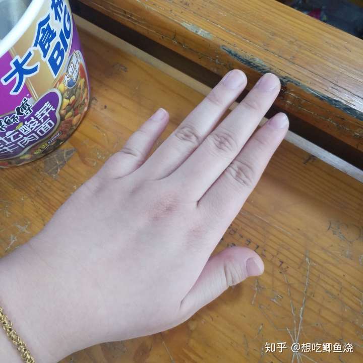 為什麼我的大拇指又寬又短?