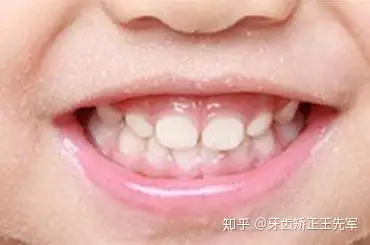 什么是地包天地包天有哪些危害
