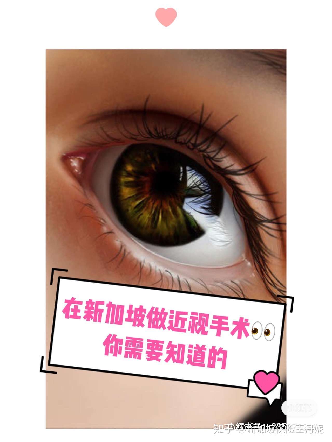 在新加坡做近视手术 你需要知道的 一 知乎