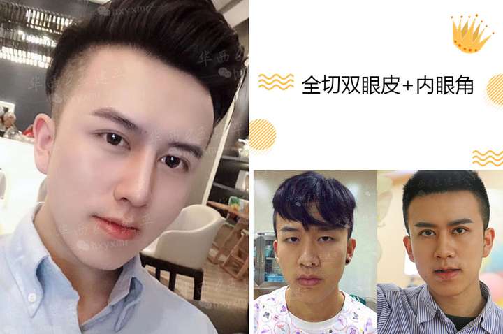 如何看待高考結束後扎堆割雙眼皮,其中男生佔比 20%?