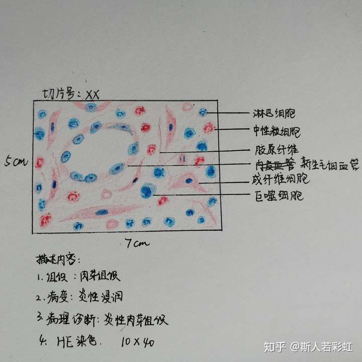 肉芽組織和血栓的紅藍鉛筆手繪圖怎麼畫救救孩子吧