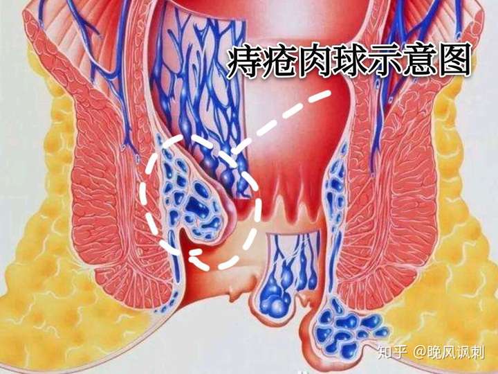痔疮好久了,最近上厕所发现便后出血,觉得不好意思就没有去找医生看过