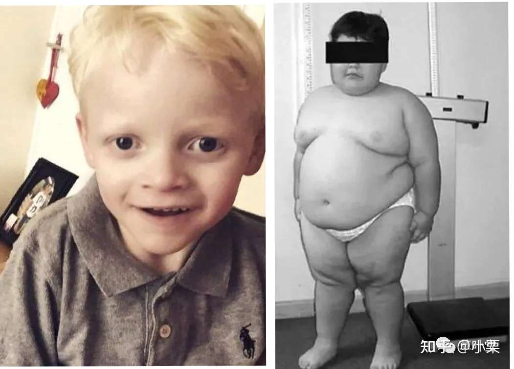 草叶科普之 天使综合症和小胖威利症 知乎