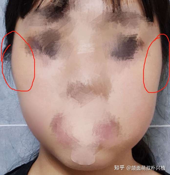 两边脸特别不对称怎么办?