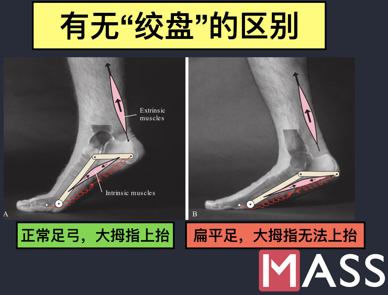 足底筋膜炎的自我恢复方法 知乎