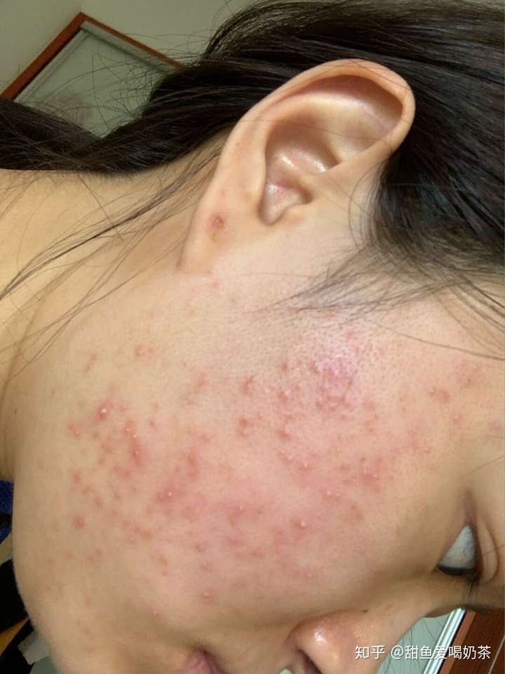 脸上的痘痘用什么产品可以去掉?