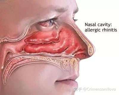 详解孩子过敏性鼻炎和处理方法 家长多了解 对症治疗 知乎