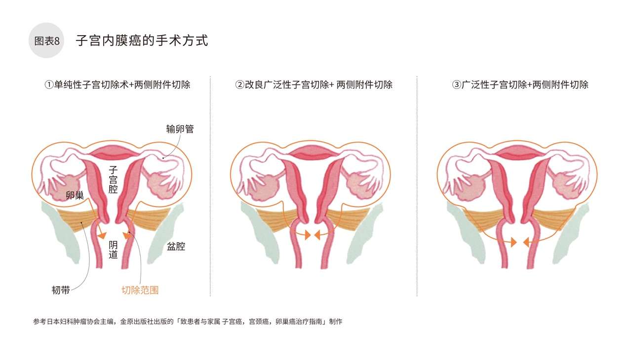 日本专家谈肿瘤 子宫癌 知乎