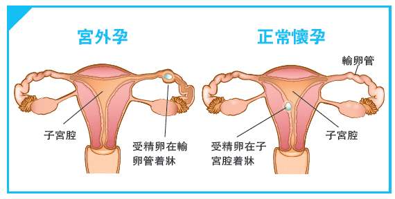 宫外孕是怎么引起的 宫外孕的症状及诊断 知乎