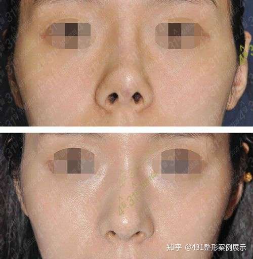 金载勋隆鼻后鼻孔外露修复案例