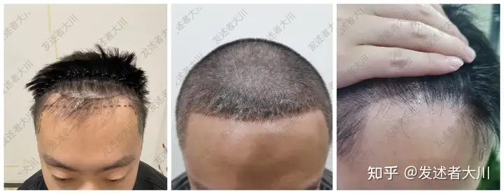 植发有用吗？哪家医院好？四大家“雍禾 大麦 碧莲盛 新生”优缺点对比,看完你就知道怎么选！丨植发哪家做的好