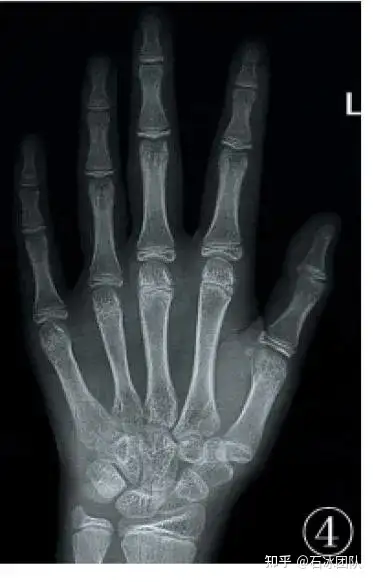 贾仲林副教授谈谈kallmann综合征