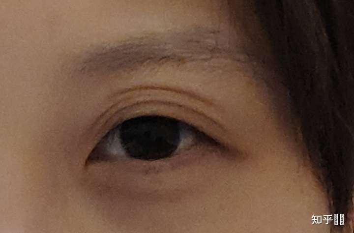 熬夜后皮肤松弛,松弛导致皱纹,只不过这条皱纹刚好跟双眼皮皱褶趾合