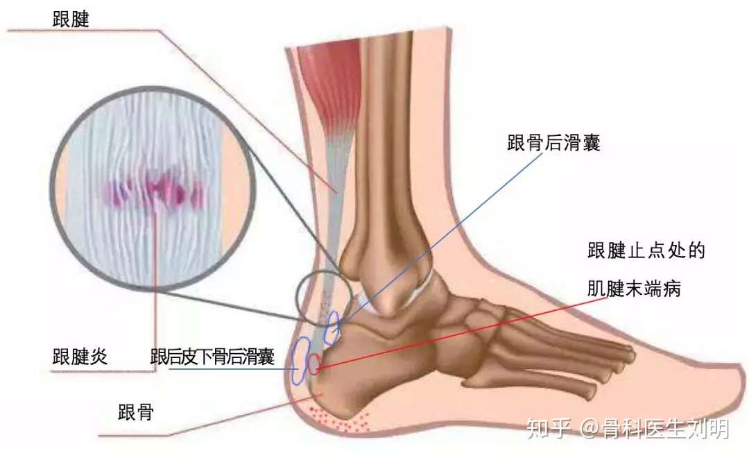 一文带你了解足跟痛 知乎