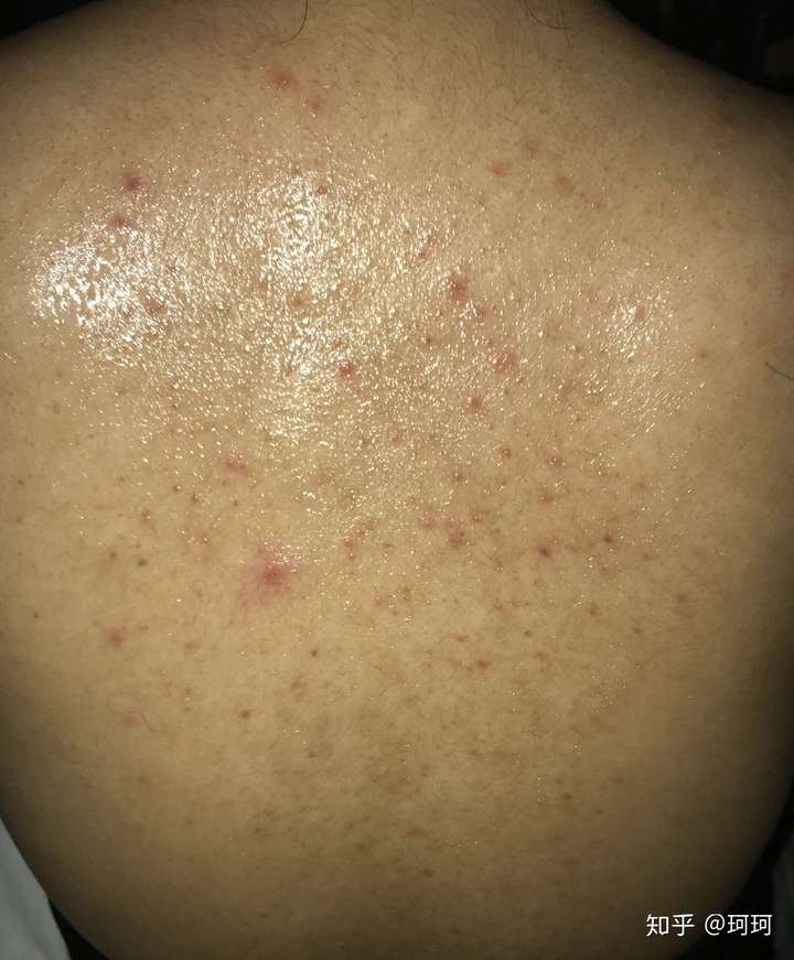 求问后背很多痘印痘痘怎么办?
