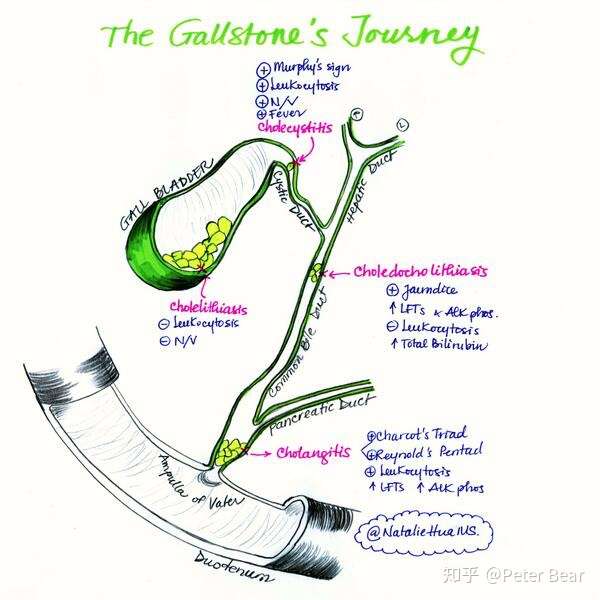 药剂师学习笔记之急性胆囊炎和胆管炎 Cholangitis And Cholecystitis 知乎