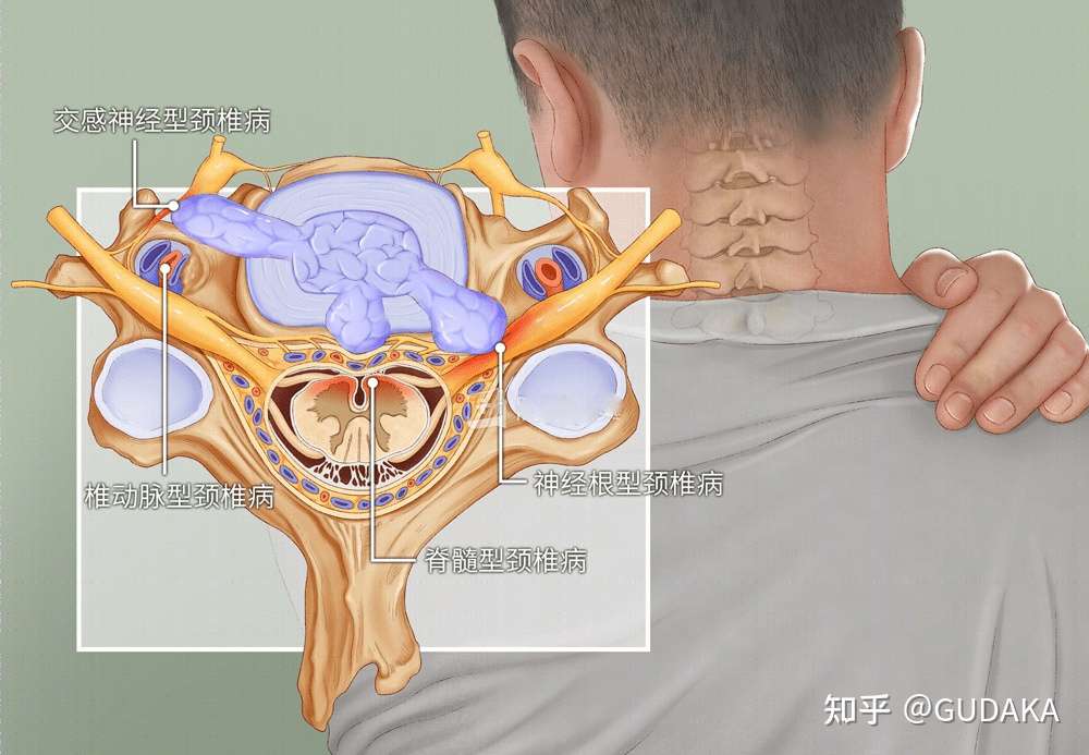 颈肩部疼痛 手臂麻木 可能是颈椎病 知乎