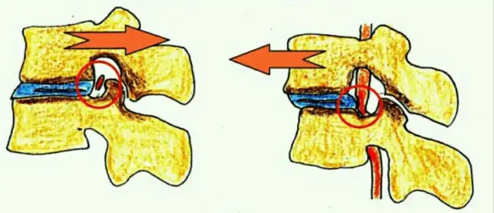 腰5椎体1度滑脱严重吗?腰椎滑脱日常需要注意什么?插图1 腰5椎体1度滑脱严重吗?腰椎滑脱日常需要注意什么?插图1