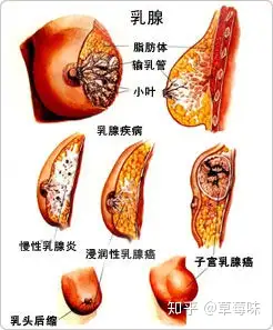 1,乳房皮肤改变:通过乳腺癌的早期症状图片我们能够明显的发现乳腺癌