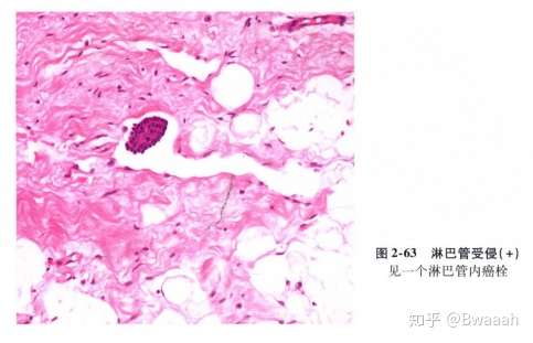 从初诊到康复 一文读懂乳腺癌 知乎