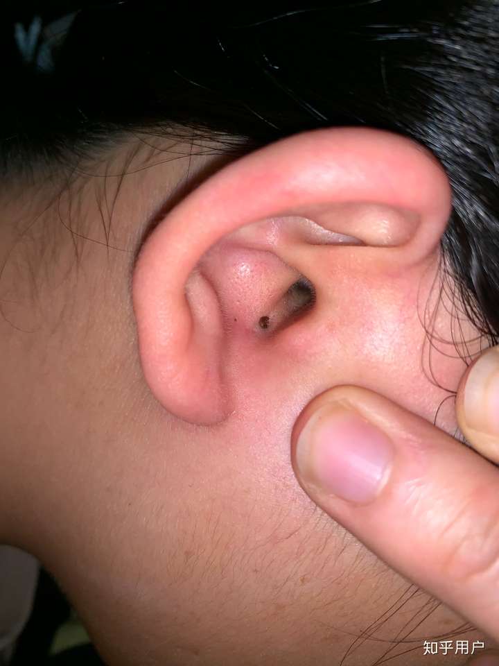 黑头大到直接挤出来是什么感受?